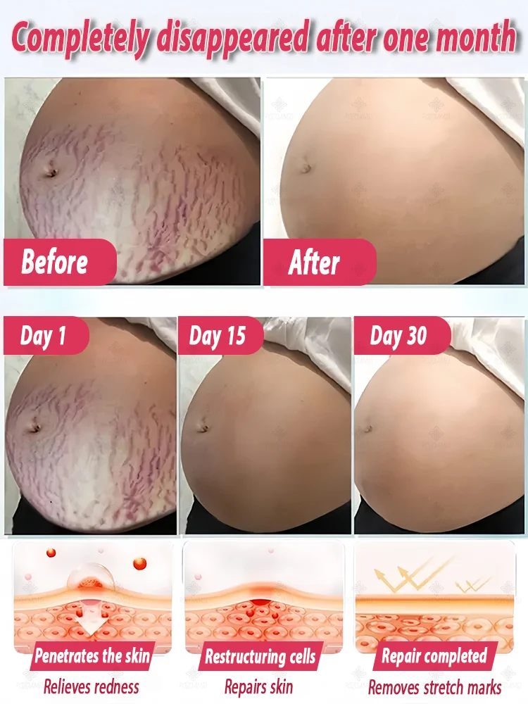 Stretch mark repair, easy removal at home