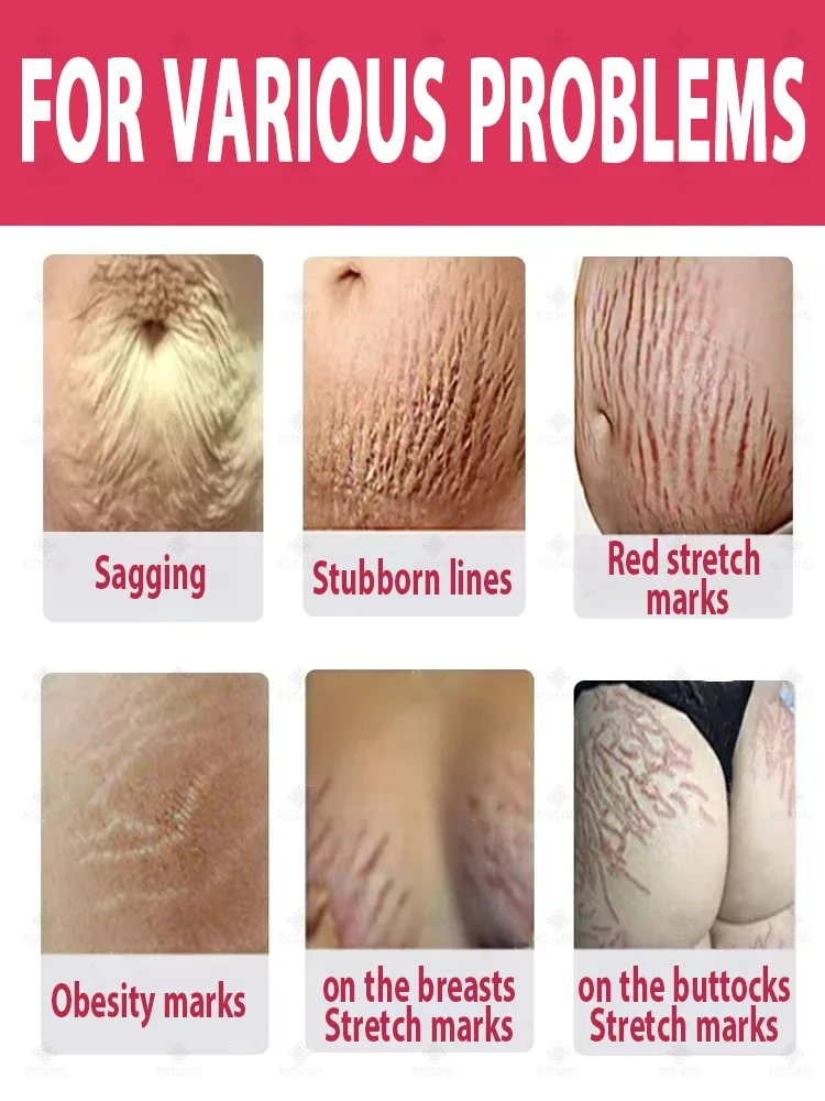 Stretch mark repair, easy removal at home