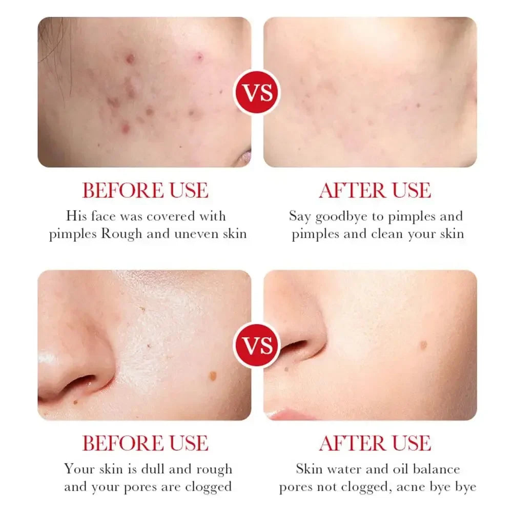 Salicylic Acid Shrink Pore Cream Elimination Large Pores Remove Blackehead Face Smooth Repairing Skin Care Product