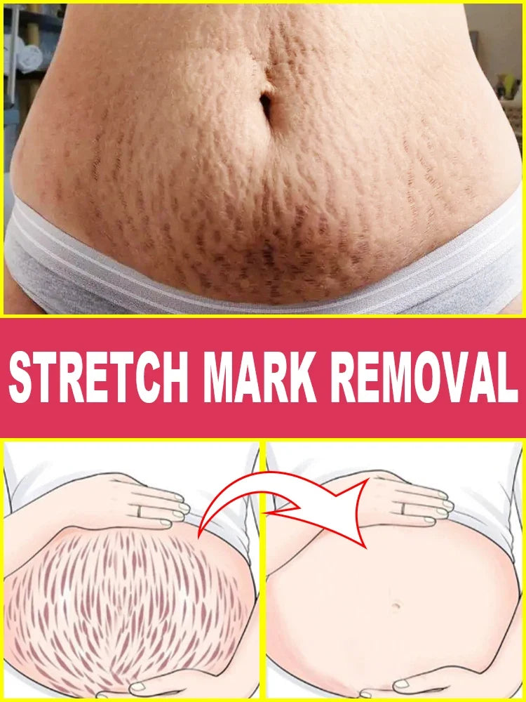 Stretch mark repair, easy removal at home