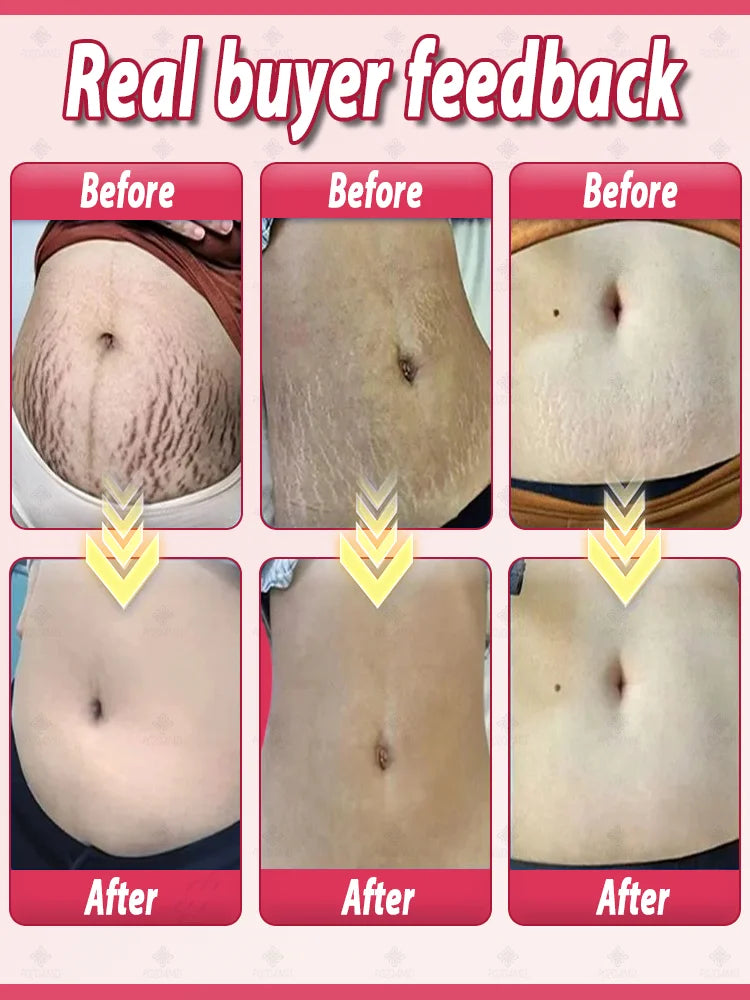 Stretch mark repair, easy removal at home