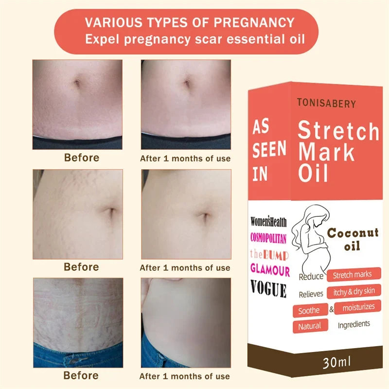 Stretch Marks Remover Essential Oil Pregnancy Maternity Body New Old Stretch Mark Removal Serum Increase Elasticity of Skin