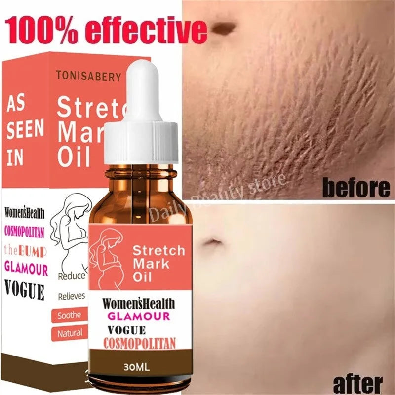 Stretch Marks Remover Essential Oil Pregnancy Maternity Body New Old Stretch Mark Removal Serum Increase Elasticity of Skin