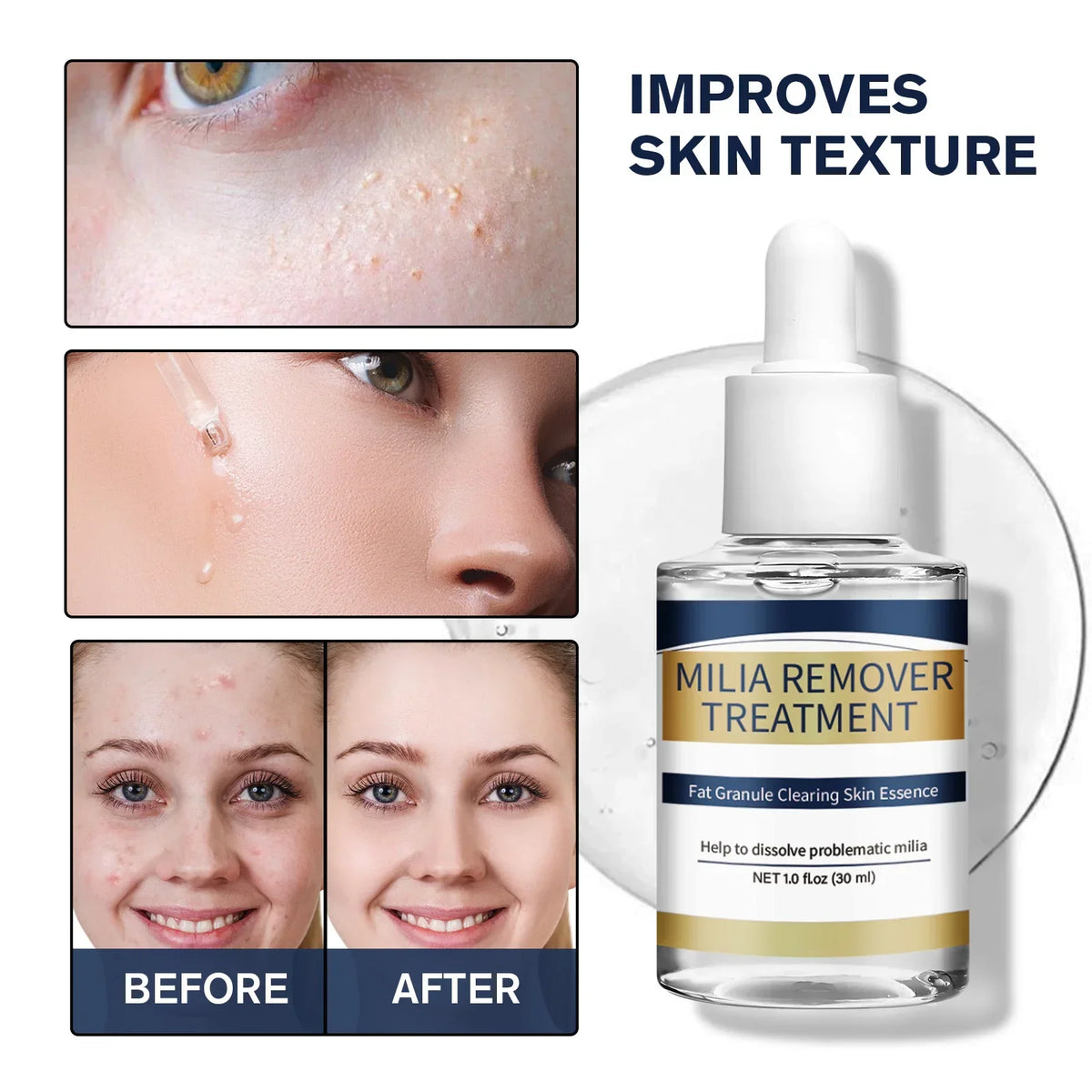 Milia Remover Essence Treatment Fat Granule Clearing Skin Hyaluronic Acid Deep Hydration and Gentle Exfoliation Hydrates Smooths