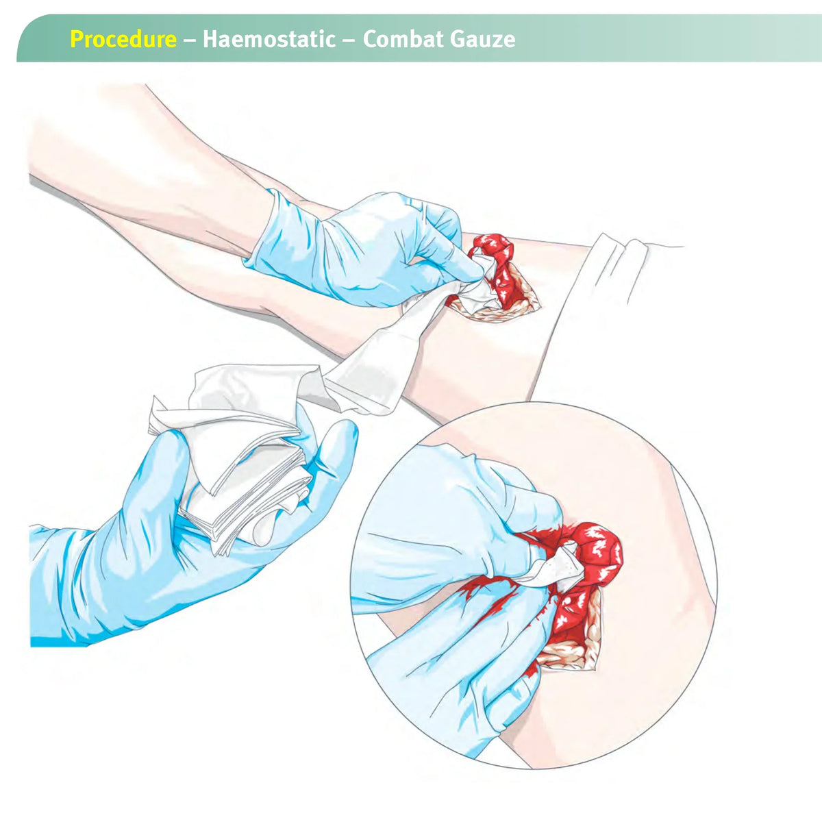 Hemostatic Kaolin Gauze Combat Emergency Trauma Z-Fold Soluble For Ifak Tactical First Aid Kit Medical Wound Dressing